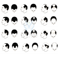 【佳學基因檢測】過早<font color='red'>脫發(fā)</font>、掉發(fā)太多怎么辦？你的方法可能是錯的！