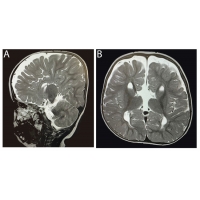 <b>【佳學(xué)基因檢測】唐奈-巴羅綜合征基因檢測（DBS)及其治療</b>