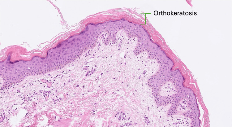圖3. 魚鱗病皮膚活檢的組織病理學(xué)。