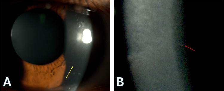 圖2. 明顯的角膜神經(jīng)和點狀深層基質(zhì)混濁。
